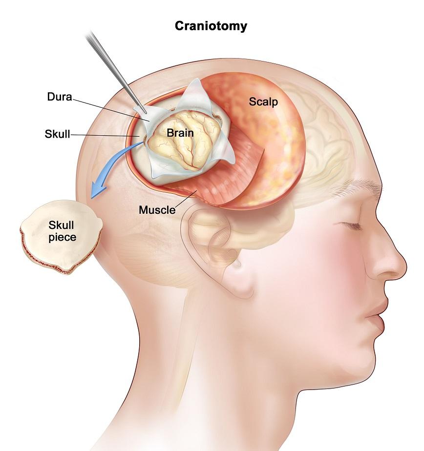 Meningioma surgery