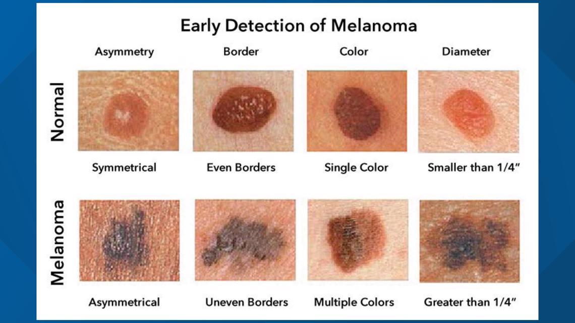 Melanoma