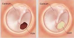 eardrum