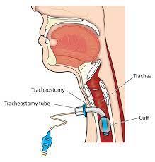 Tracheostomy Cost in India: A Comprehensive Guide