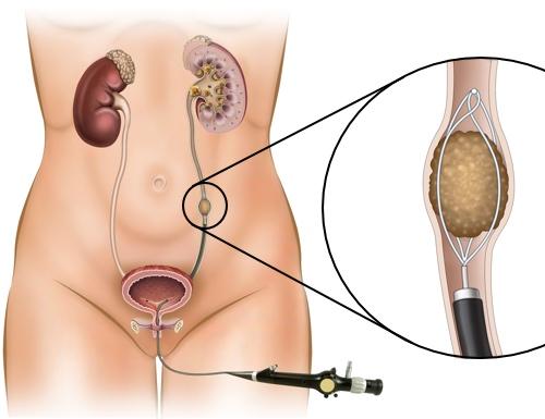 Ureteroscopy