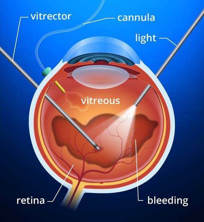 Vitrectomy surgery