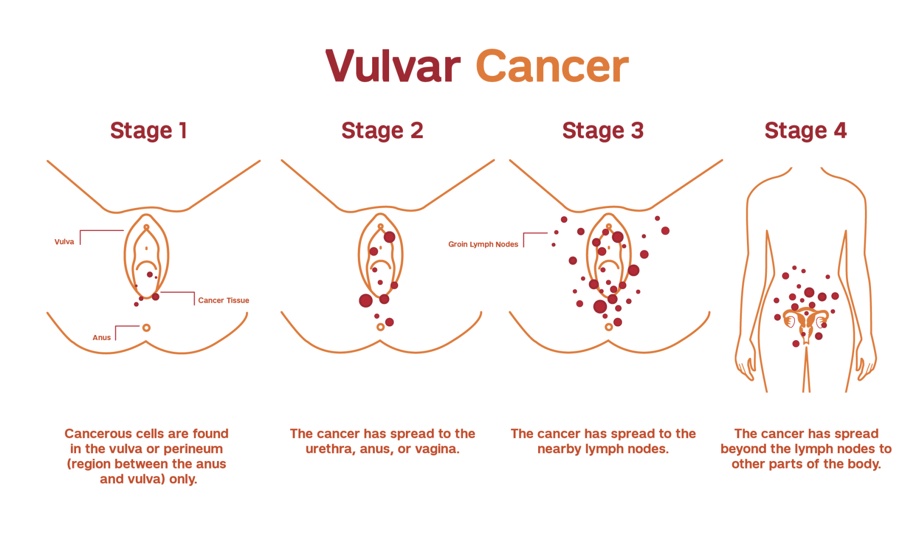 Types of Cancer and cancer treatment options. Be Informed.