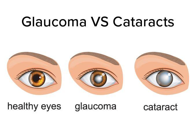 glaucoma